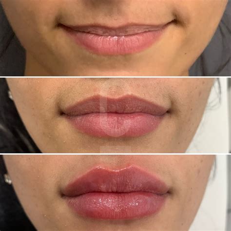 Lip Implant Sizes