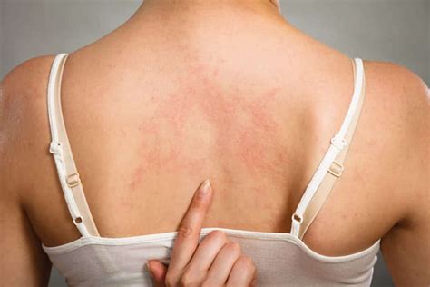 Hep C Symptoms - Could Your Rash Be One? | Hepatitis Central