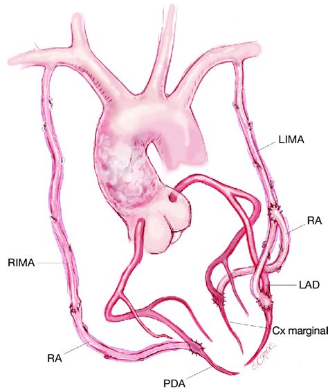 Illustration of bilateral internal mammary artery grafts. RIMA, right... | Download Scientific ...