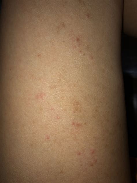 Help needed to identify skin rash condition