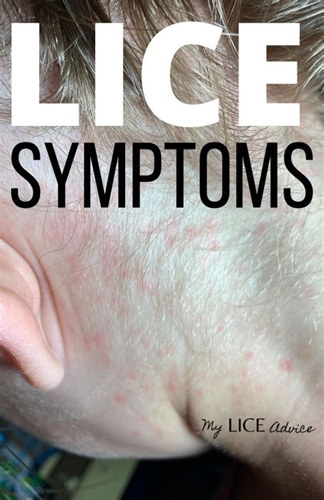 17 Lice Symptoms with Pictures: Signs That You Have Head Lice in 2020 ...