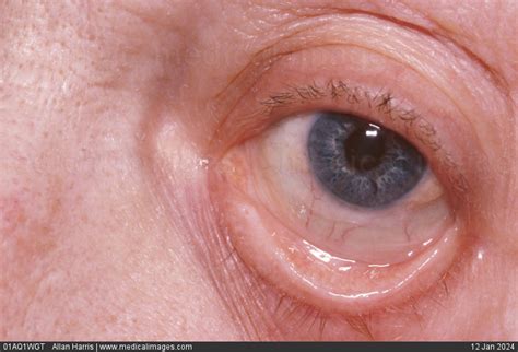 Anemia Signs In Eyes