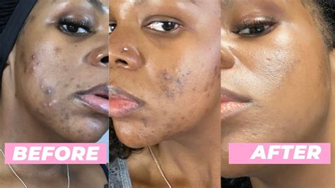 How to Get Rid of Dark Spots from Acne on Black Skin (at Home) - YouTube