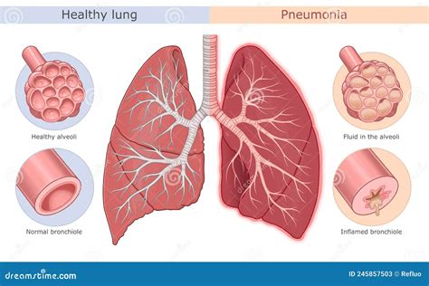 Pneumonia Symptoms Medical Diagram Stock Vector - Illustration of ...