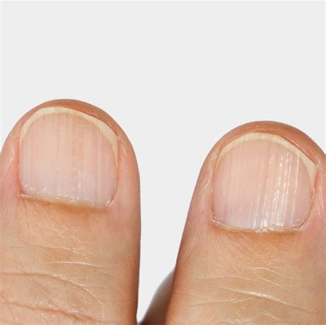 Ridges in Nails: Causes, Treatments and Prevention