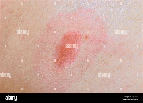 Target Rash from Deer Tick Bite Transmitting Lyme s Disease Stock Photo ...