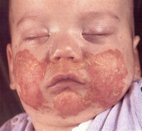 Zinc Deficiency Acrodermatitis Enteropathica