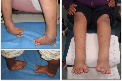 clubfoot surgery adult and pediatric ilizarov — Specialized Foot & Ankle Surgery