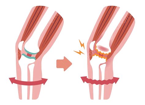 Causes Of Knee Pain Gonarthrosis Osteoarthritis Arthrosisflat Illustration Vector, Joints ...