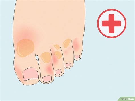 How to Treat Trench Foot: Symptoms & Causes (With Pictures)