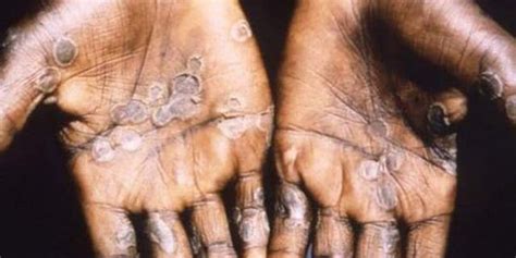 Monkeypox in US: CDC monitoring 200 people in 27 states, other ...