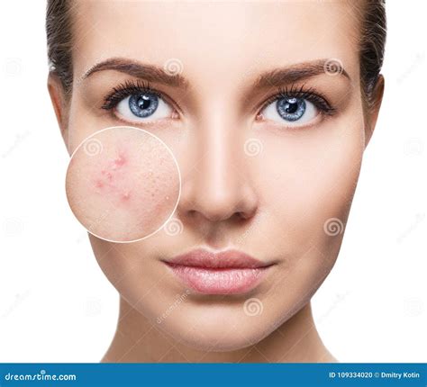 Acne Skin Texture Stock Photography | CartoonDealer.com #12499106