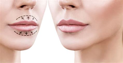 Lip Injections Aftercare | Toronto Plastic Surgery Center