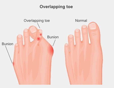 Overlapping and Underlapping Toes - The Foot and Ankle Clinic