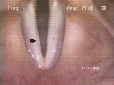 Sulcus Vocalis: Practice Essentials, History of the Procedure, Problem