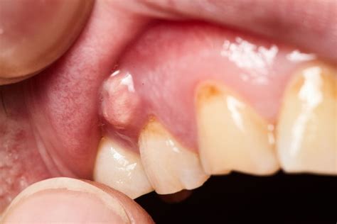 Gum Blister: 7 Common Causes (& What to Do) - Tua Saúde