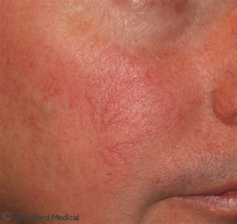 Top 104+ Pictures Rosacea On Neck Pictures Superb