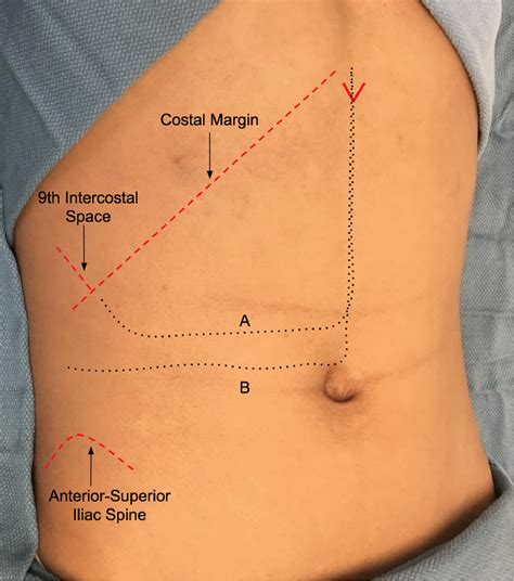 Open adrenalectomy through a makuuchi incision: A single institution's ...