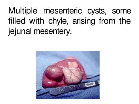 mesenteric cyst