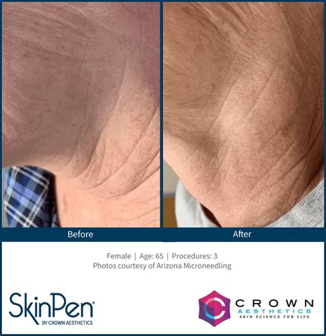 Skin Pen Before and After | Skin Pen Microneedling