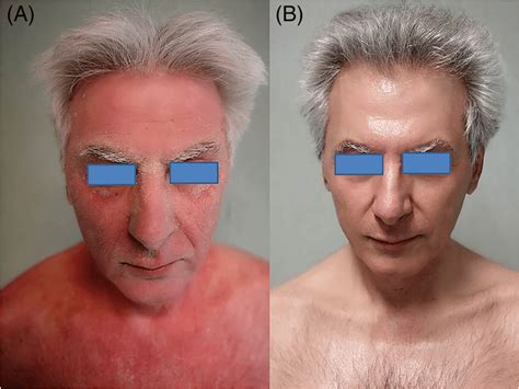 Case 1 A, before and B, after 5 months of acitretin + nb‐UVB treatment;... | Download Scientific ...