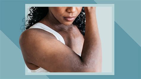 Eczema in Black Skin: Symptoms, Diagnosis, Treatment