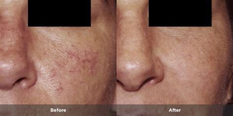 Rosacea Treatment Photos | Rosacea.org