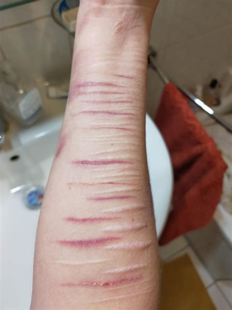 A long scar from a fat cut and a big scar from a deep burn. : SelfHarmScars