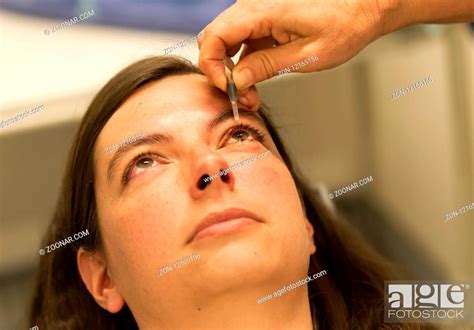 Healthcare concept - Chalazion during eye examination and operation - Female, Stock Photo ...