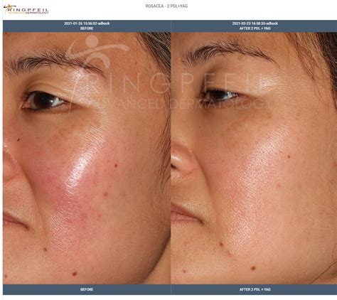 Rosacea Cheeks Treatment