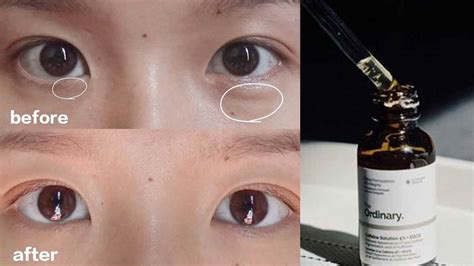 Say Goodbye to Dark Circles: The Ordinary Caffeine Solution Before and After - Glowing Gorgeous