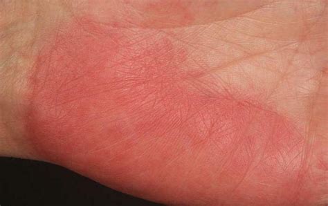 Palmar erythema - symmetrical reddening of the palms: causes and treatment