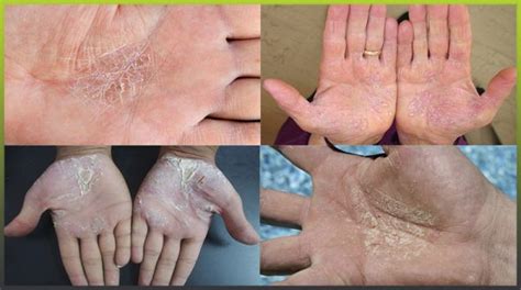 Psoriasis on the hands and palms | Psoriasis expert