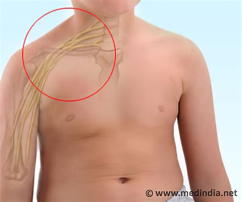 Brachial Plexus Injury Symptoms