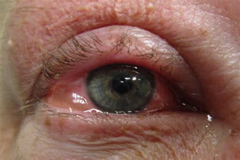 Allergische conjunctivitis: oorzaken, symptomen en preventie | Live noodgeval