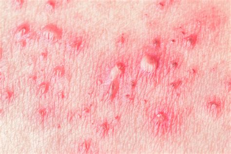 Hives Treatment and Remedies | U.S. Dermatology Partners