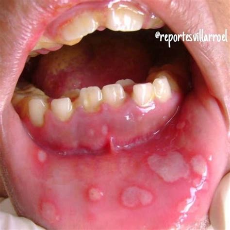 List 97+ Pictures What Does Herpes In The Mouth Look Like Updated