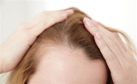 Hair Loss and Thyroid - Dynamic Life Health Center