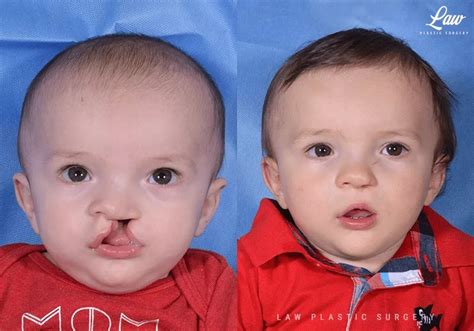Cleft Lip Repair Before After Photos Law Plastic Surg - vrogue.co