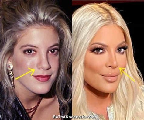 Tori Spelling Plastic Surgery Comparison Photos