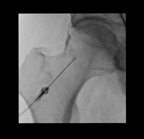 Hip arthrogram injection (fluoroscopic guided) | Image | Radiopaedia.org