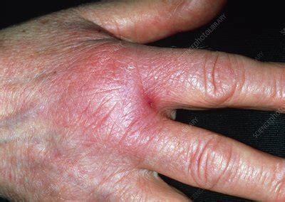 Cellulitis on hand - Stock Image - M130/0590 - Science Photo Library