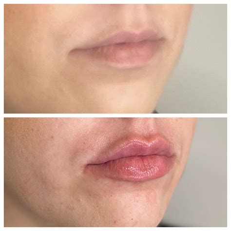 B&A #10: RHA 3 Lip Filler | Saintly Skin