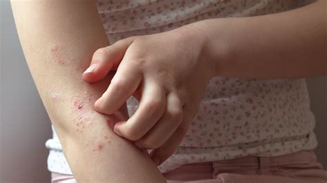 Is Eczema an Autoimmune Disease? Causes, Symptoms, and Treatment - GoodRx