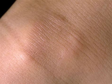 Granuloma Annulare - Subcutaneous Type | Perri Dermatology