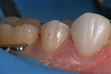 Composite Veneers to Reduce Buccal Corridor