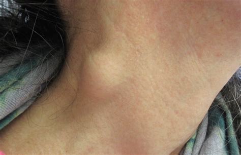 What Is This Asymptomatic Mass on the Side of a Woman’s Neck? | Consultant360