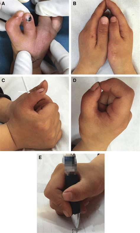 a 33-month-old boy (case 1) with right Wassel type Vi radial... | Download Scientific Diagram