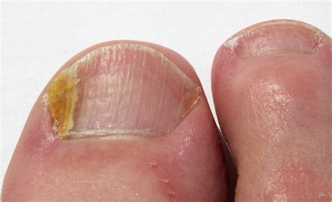 What Causes Fungal Nail Infection? Treatment, Symptoms & more