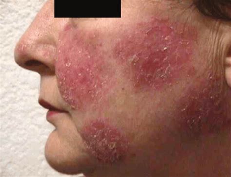 Pemphigus Vulgaris Treatment | Dr. Thind's Homeopathy